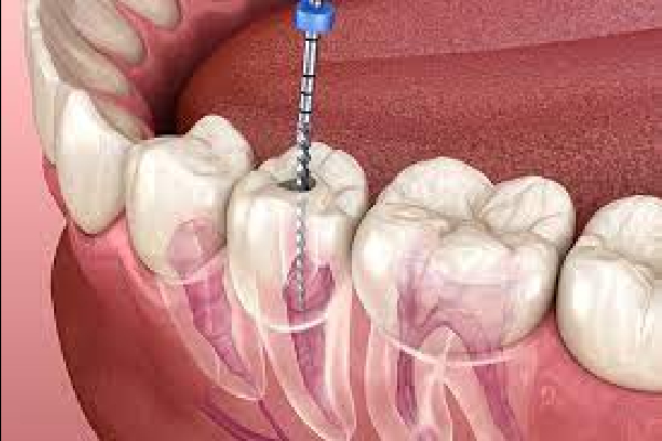 Endodontics